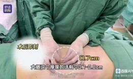 爆料桂哥抽脂视频大全下载,揭秘网红抽脂全过程